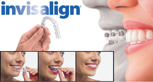 Invisalign graphic